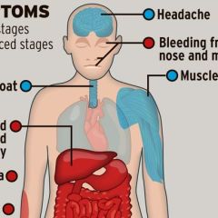 Health Care Worker at Dallas Hospital Tests Positive for Ebola