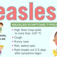 Measles Cases in Texas Town; Not seen in 20 Years