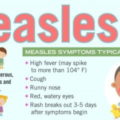 Measles Continues to Spread Especially in Unvaccinated Children